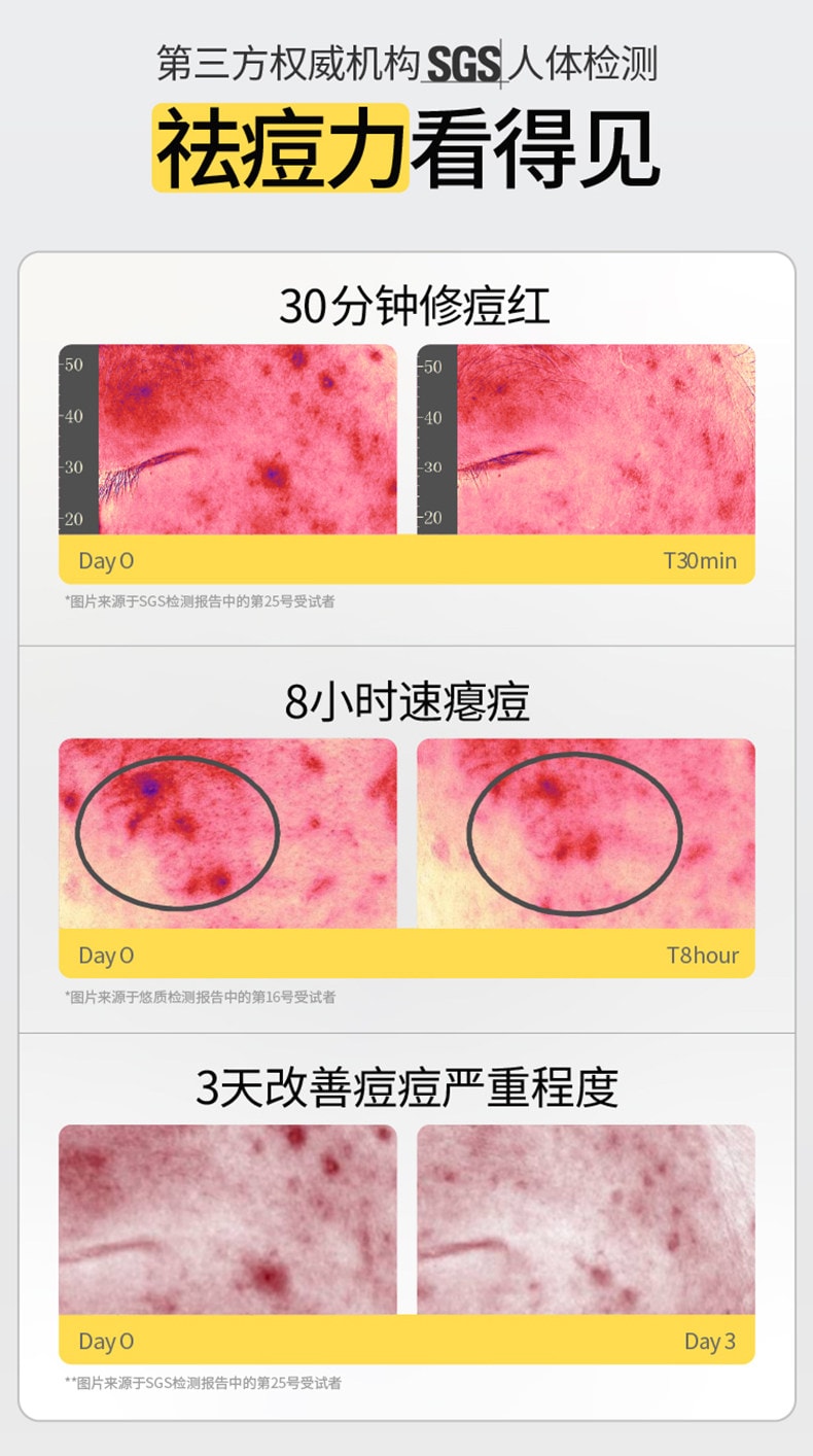 【中国直邮】 羽素 【陈梦同款】祛痘大灯泡 Ⅲ快速去痘 修护舒缓 痘肌精华液 【精准祛痘 痘肌天菜精华】15ml*1瓶