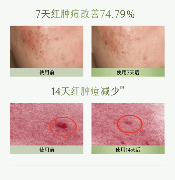 谷雨 【專為油痘肌研發-水乳霜套裝】白千水乳霜套裝【祛痘平閉口】【8小時持效控油】【更適合亞洲人膚質】舒緩修護 補水保濕 收縮毛孔 (細膚爽膚水150ml + 淡印乳液100ml + 控油面霜50g)