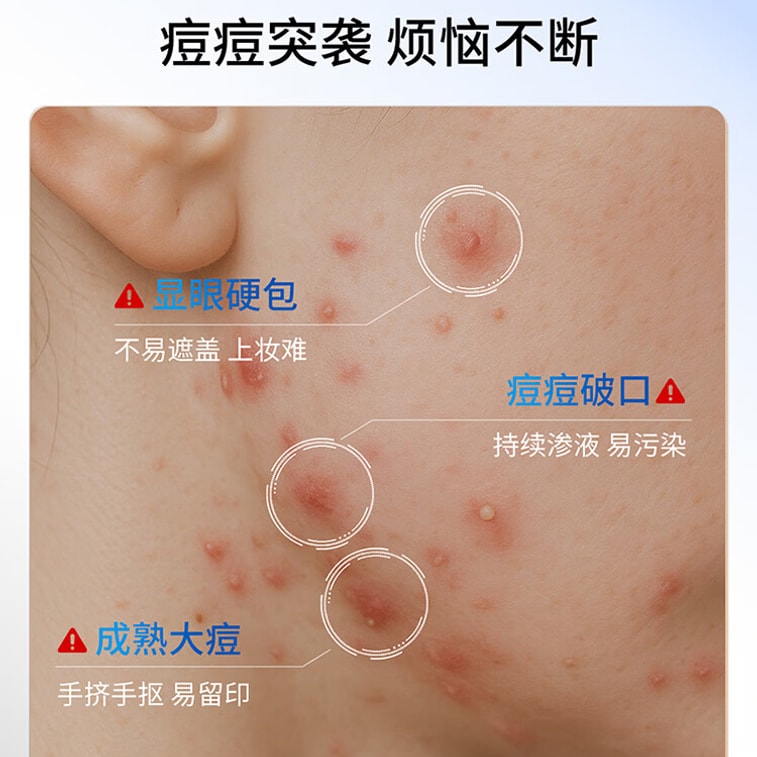 Acne Patches 36pcs - Invisible Hydrocolloid Pimple Patches, Absorb Exudate & Flatten Zits Overnight, Waterproof & Makeup Friendly 6