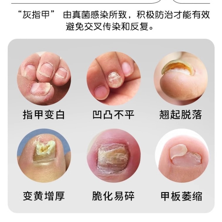【中國直郵】 洛芙 鹽酸阿莫羅芬搽劑 灰指甲灰指甲專用藥阿羅莫芬搽劑 5%*2ml*1瓶/盒 3