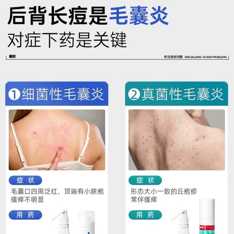 115【中国直送】Liv リン酸クリンダマイシン外用液 毛包炎 前胸部・背中ニキビ スプレー 背中ニキビ・ダニ除去 30ml 3