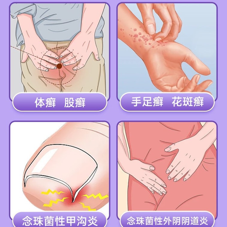 【중국 직배송】 부염길 클로트리마졸 크림 15g 【항균 가려움 완화·진균 퇴치·다양한 백선에 사용】 1%*15g 1개 무좀, 사타구니 백선, 손발 무좀, 어루러기, 두부 백선, 칸디다성 조갑주위염, 외음부 질염 【진균 감염 환자·가려움증 및 백선 환자·부인과 염증】 국소 외용 항생제 계열 OTC 항진균 연고 3