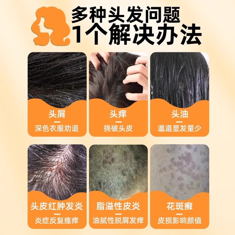 [중국 직배송] 시왕 셀레늄 설파이드 샴푸, 심한 비듬, 가려움증, 건조 두피, 백선균 감염에 효과적인 특수 의약품, 100g/병 3
