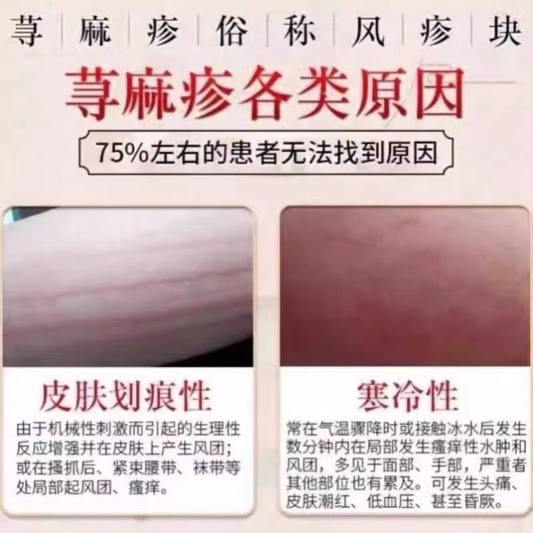 Guizhou Miao Medicine Urticaria Dermatitis Skin Protectant Eczema Ointment Skin Itching Allergy Antibacterial 20g 4