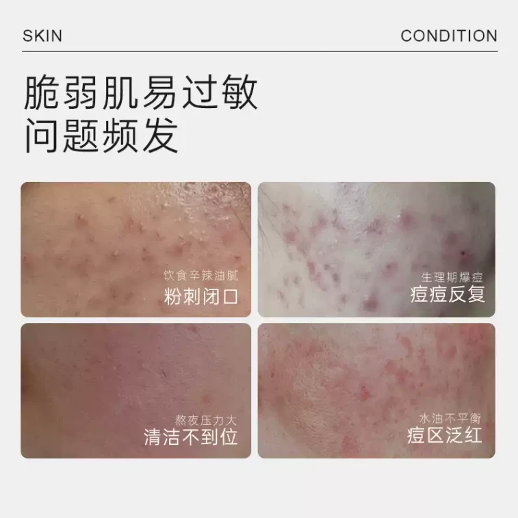 Acne Clearing Repair Mask 5 Sheets 4