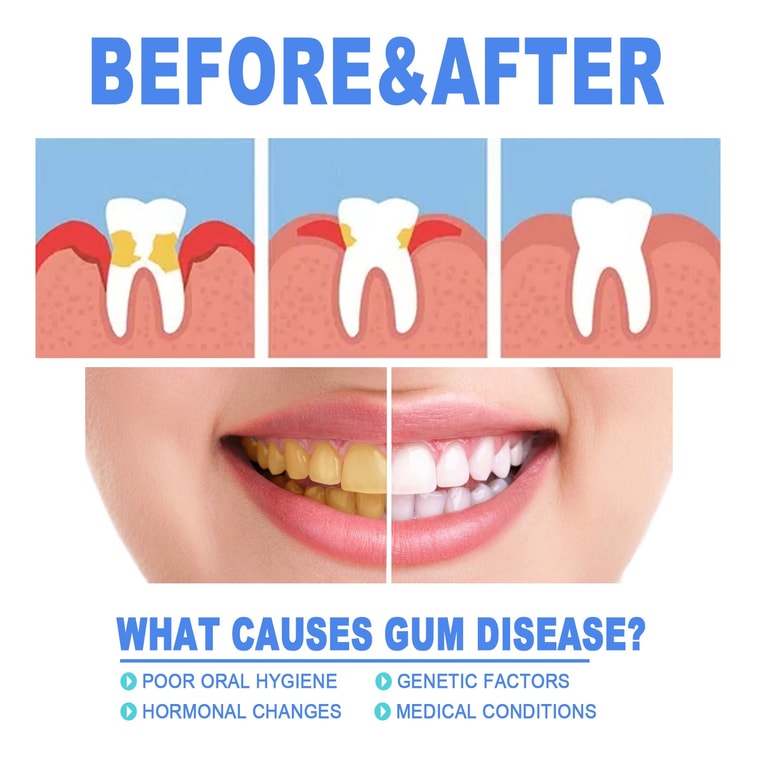 Tooth Repair Gel Repairs Gum Swelling And Pain Deep Cleans Tooth Stains And Plaque Oral Care Gel 4ML 6