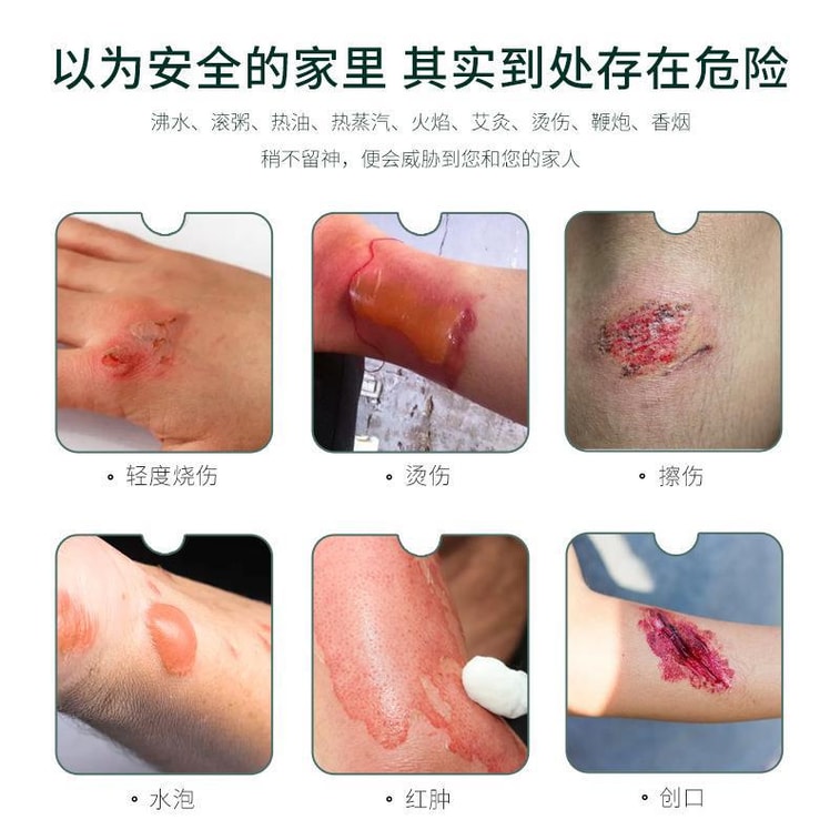 【中国直送】Jianyisheng 火傷冷却ジェル、軽度の火傷、赤み、水ぶくれ、傷跡の緩和、傷の鎮静に、20g/チューブ 3