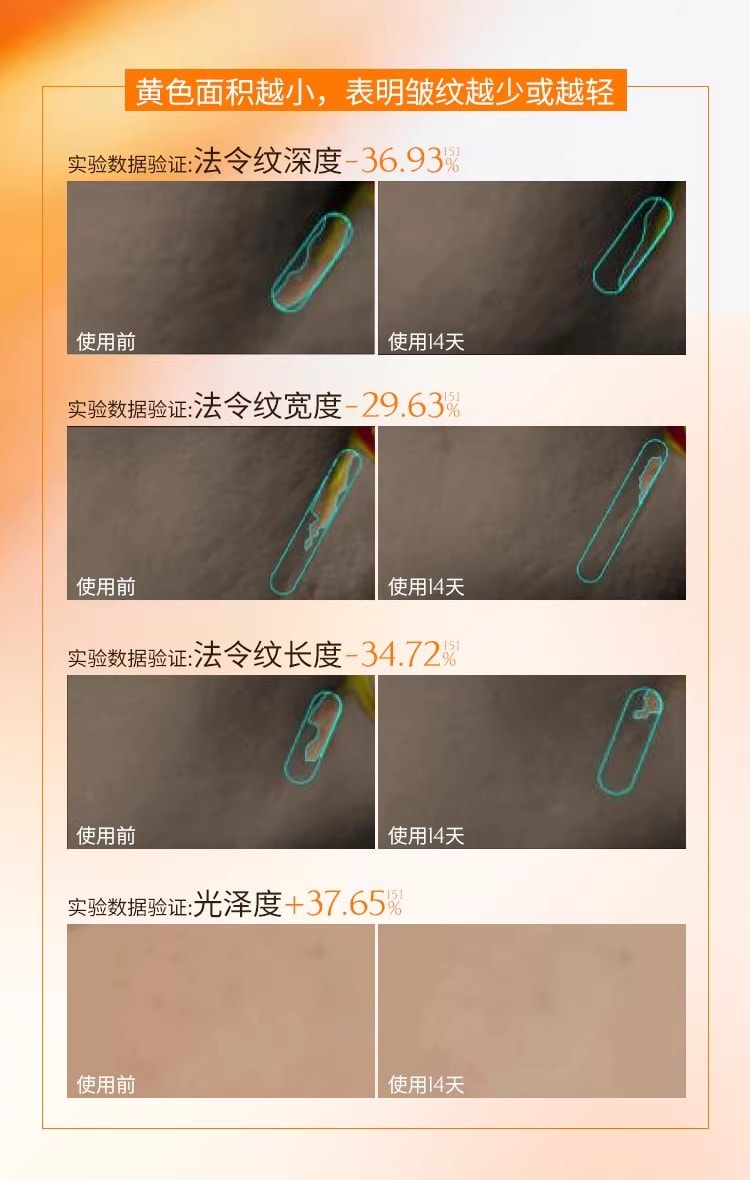 【中国直邮】 奢笛熊 微雕冻干法令纹贴 睡觉专用抗皱紧致面膜局部贴 玻色因淡纹贴 共10对