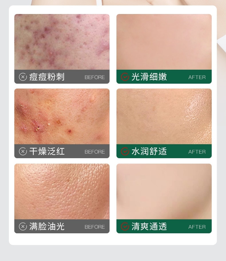 【中国直邮】 韩伦美羽 多效舒缓祛痘膏 红肿痘青春学生控油祛痘精华非修复痤疮 20g/盒