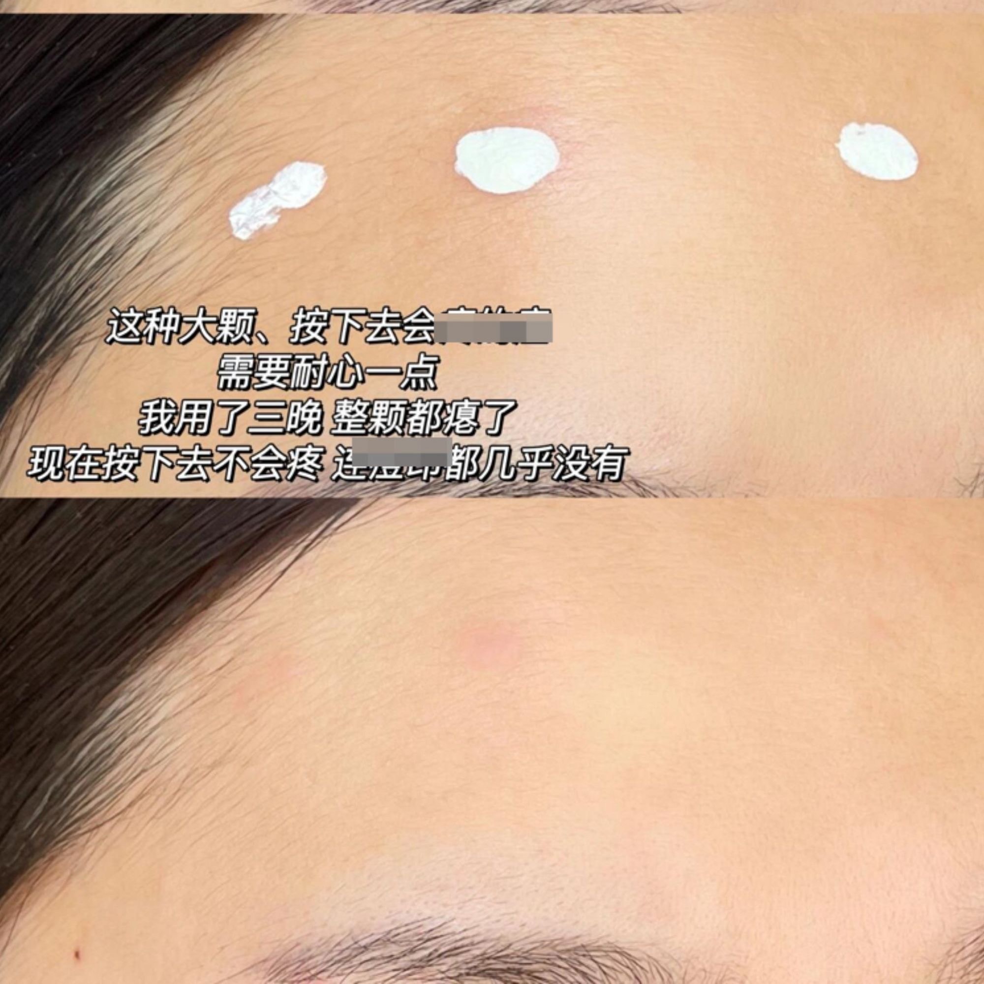 【中國直郵】 大水滴 3點祛痘精華祛痘精華液套裝10ml