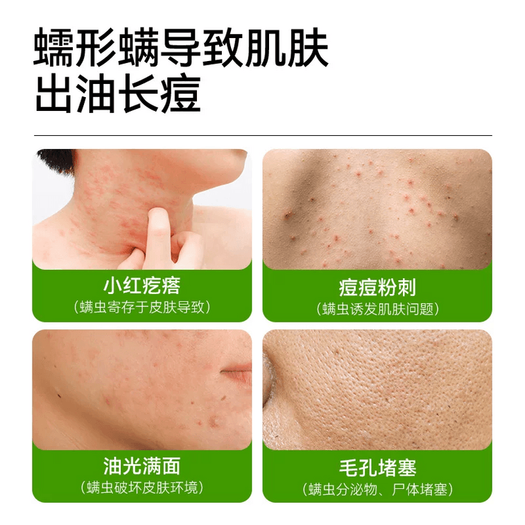 [중국 직배송] 만팅 진드기 방지, 유분 조절, 여드름 비누, 오래 지속되는 향기, 1개입 3