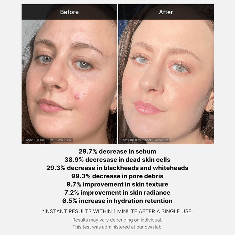 Red Acne Succinic Acid Peel 40ml 3