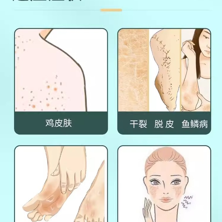 【中国直邮】 川石 尿素软膏 医用尿素霜尿素维e乳膏去鸡皮肤疙瘩毛囊角化维生素e 10%*10g/盒 3