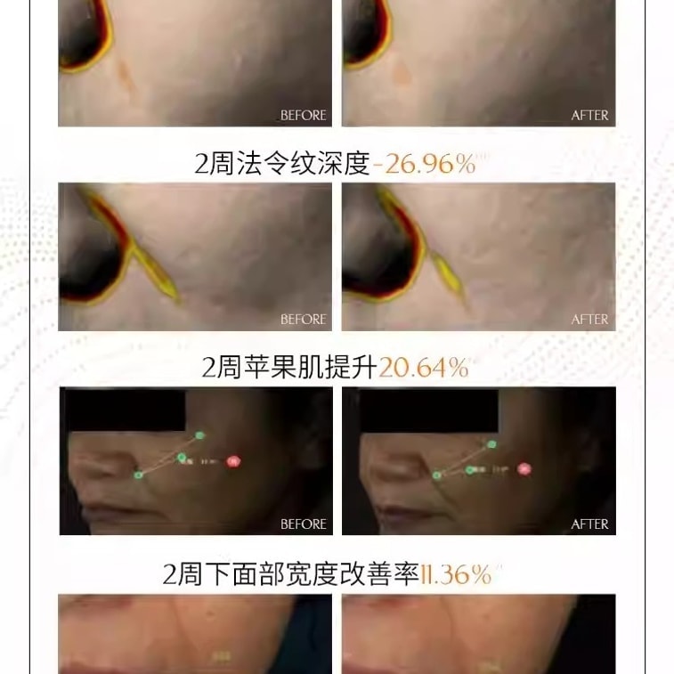 【中国直邮】 奢笛熊 微雕冻干法令纹贴 睡觉专用抗皱紧致面膜局部贴 玻色因淡纹贴 共10对 4