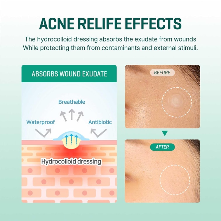 한국 썸바이미 아크네 패치 18pcs 4