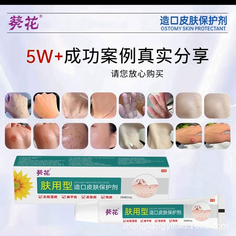 Flat wart removal ointment special wart removal ointment small flesh particle removal ointment 20g/tube 3