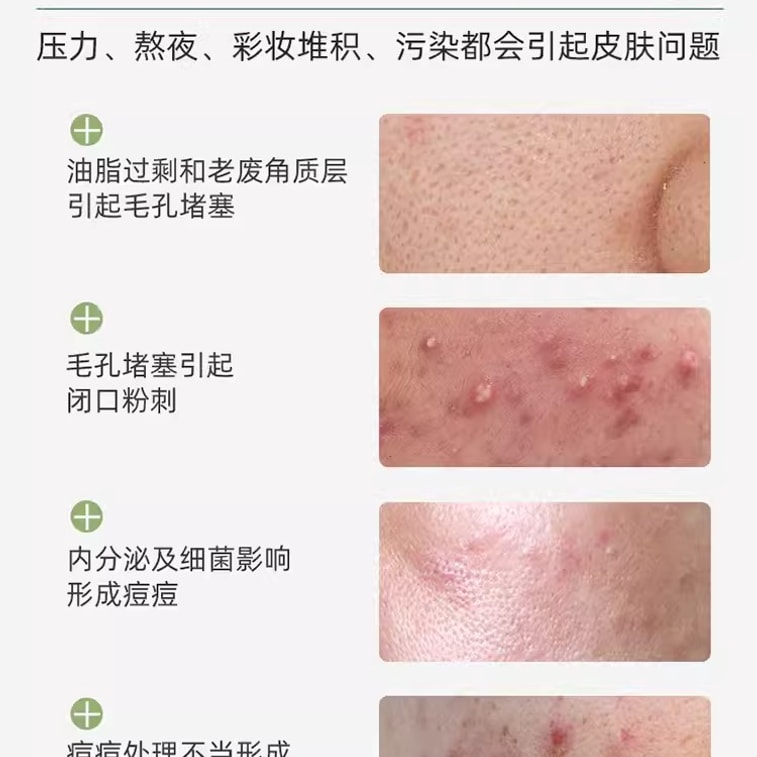 【中国直邮】 歌宝莲 / 水杨酸祛痘收缩毛孔粗大修复淡化痘印酸刷去闭口黑头粉刺凝胶精华 30g 5