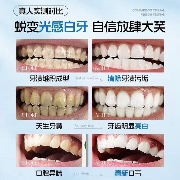 [중국 직배송] 루이 미백 치아 스트립 - 누런 얼룩과 오염 제거, 치아 미백 (7쌍/박스) 7