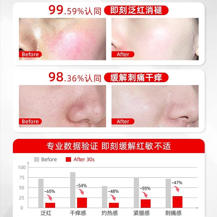 Sunburn Repair Cream for Face Neck After Sun Exposure Red Skin UV-induced Peeling Sunburn Ointment 30g/box 5