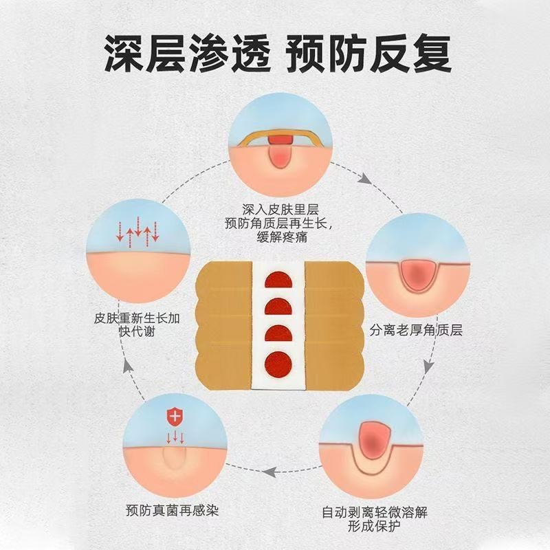 【中國直郵】 甄選好物 葵花雞眼專無痛脫落手足腳底肉刺雞眼腳刺頑固雞眼老繭雞眼貼 1盒/10貼