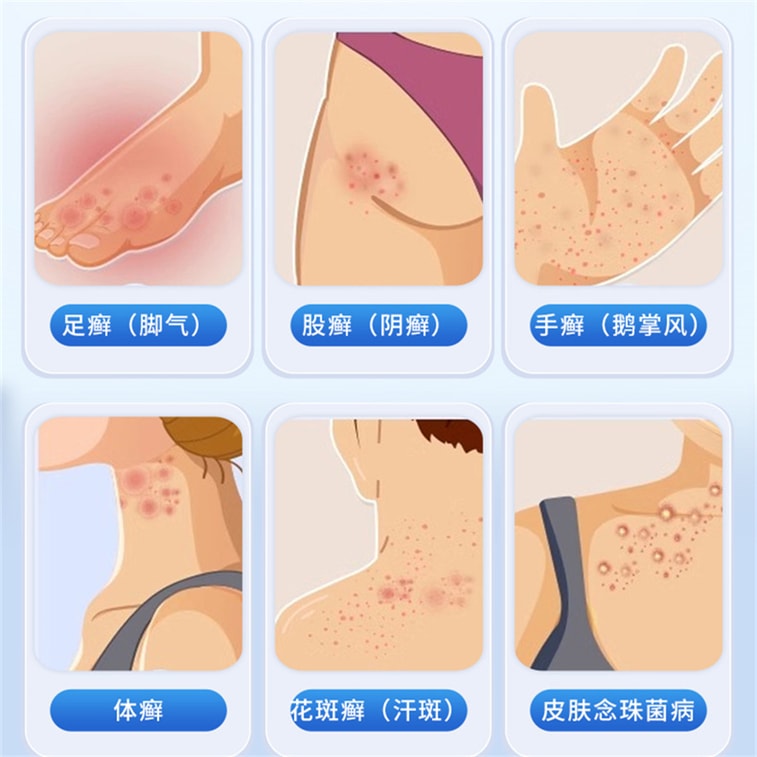 Cream - Special medicine for treating athlete's foot, relieving itching and peeling, and killing bacteria. 10g per box. 3