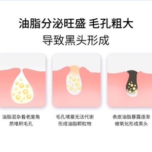 Blackhead Removal Nasal Strip Pore Cleansing Acne Treatment Mild Refreshing Non-Irritating Nasal Mask 5 Times