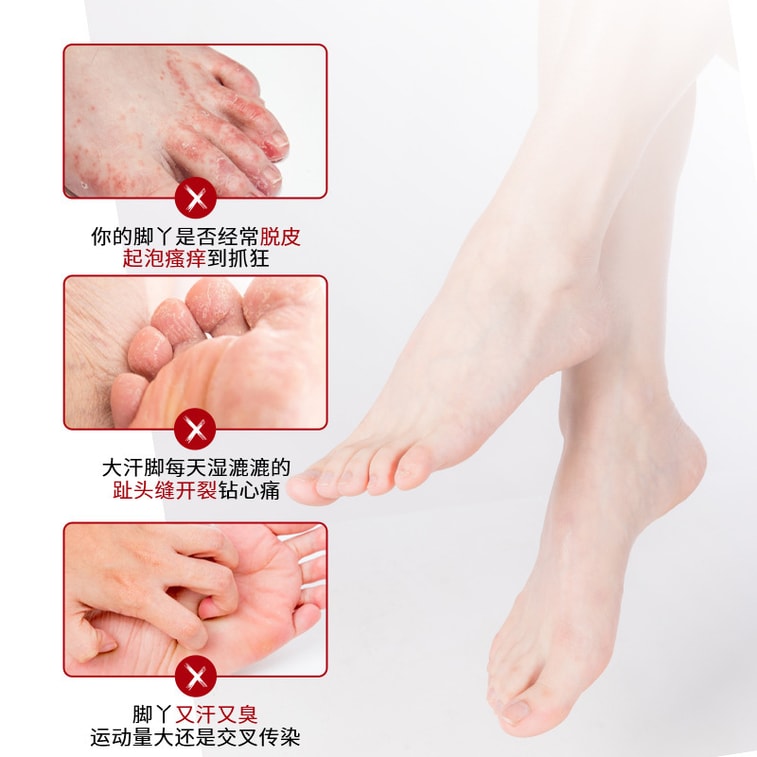 Foot Antibacterial Ointment Athlete's Foot Spray Peeling Itching Rotten And Smelly Feet Anti-itch Ointment 50g 1PC 3