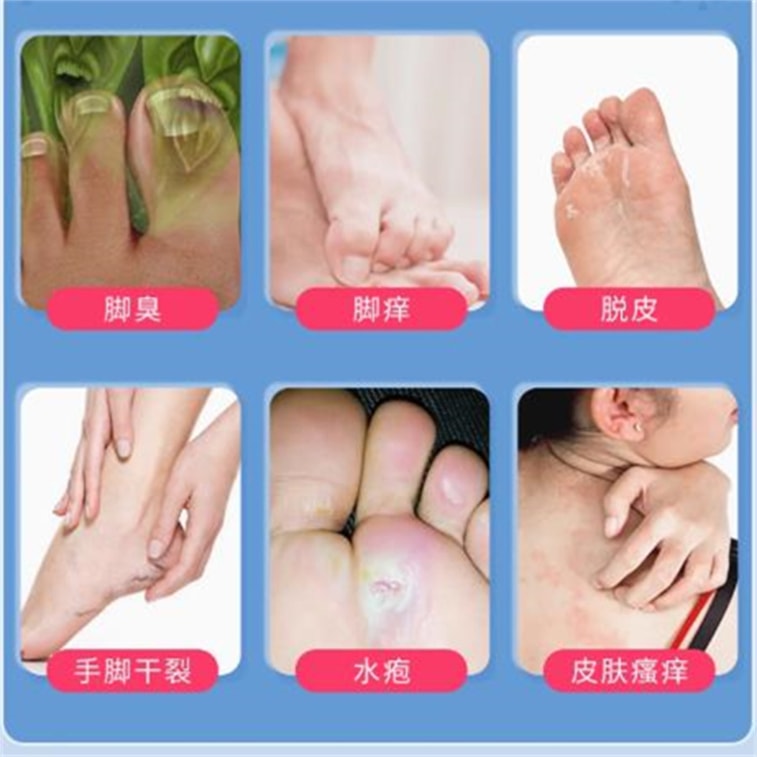 【中国直邮】 川石 复方克霉唑乳膏 用于脚气干裂止痒手藓真菌感染药膏20g/盒 4