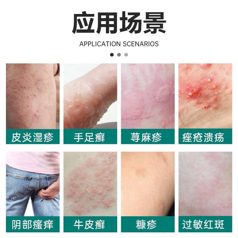 【中国直邮】 法兰度 牛皮癣型冷敷凝胶 适用于皮炎湿疹 手足癣 荨麻疹 糠疹 过敏红斑 痤疮溃疡 阴部瘙痒 10g/支