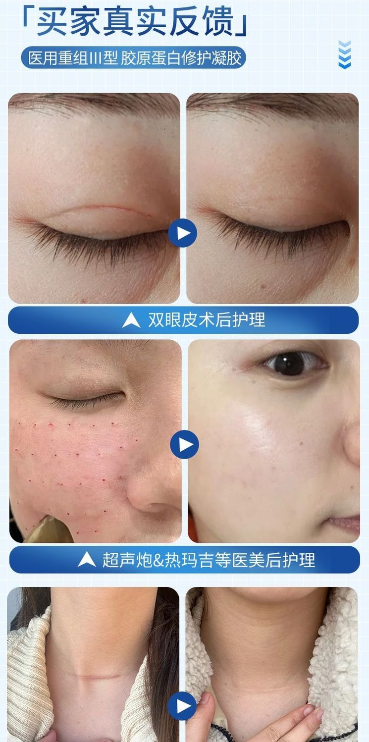 仁和 醫用級重組三型人源化膠原蛋白修護凝膠15g 預防疤痕 減輕色素沉著