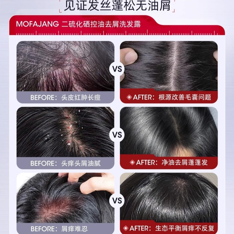 [중국 직배송] Three Magic Hairdressers 셀레늄 설파이드 비듬 방지 샴푸, 모낭 세정, 피지 조절, 볼륨 증가 및 가려움 방지 샴푸, 400ml 4