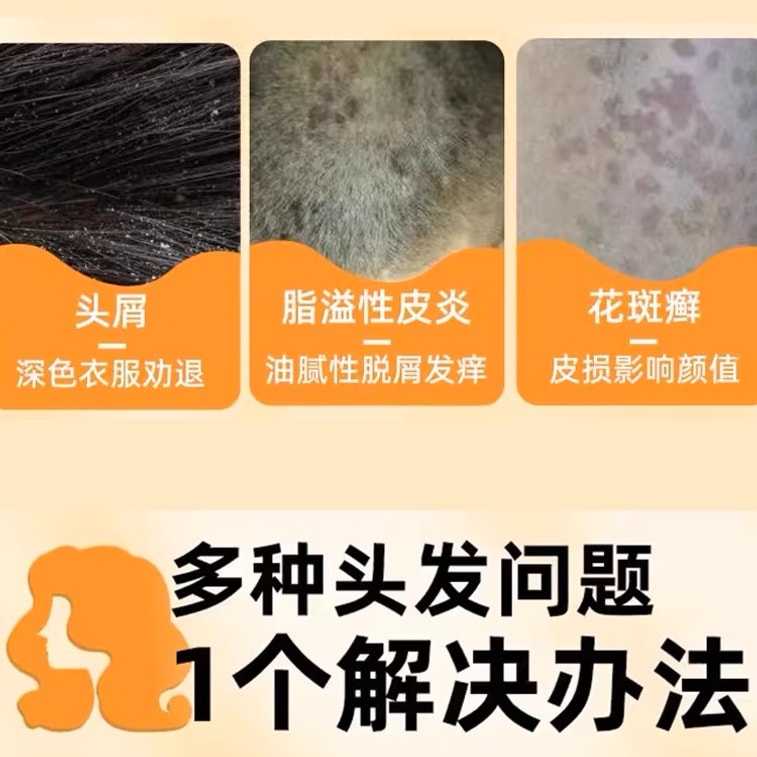 [중국 직배송] 시왕 셀레늄 설파이드 샴푸, 비듬 방지 샴푸, 지루성 피부염, 탈모, 유분 조절, 가려움증 완화, 모낭염에 적합, 100g/병 3
