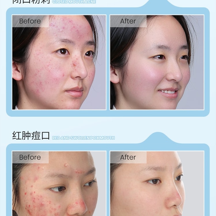 Invisible Medical Anti-Pimple Patch - Medical Hydrocolloid Dressing - Reconstructs And Reduces Inflammatory Pimple Marks - Artificial Skin Absorbs Abscesses - 36 Patches/Box - Yami.com Invisible Medical Anti-Pimple Patch - Medical Hydrocolloid Dressing - Reconstructs And Reduces Inflammatory Pimple Marks - Artificial Skin Absorbs Abscesses - 36 Patches/Box - Yami.com