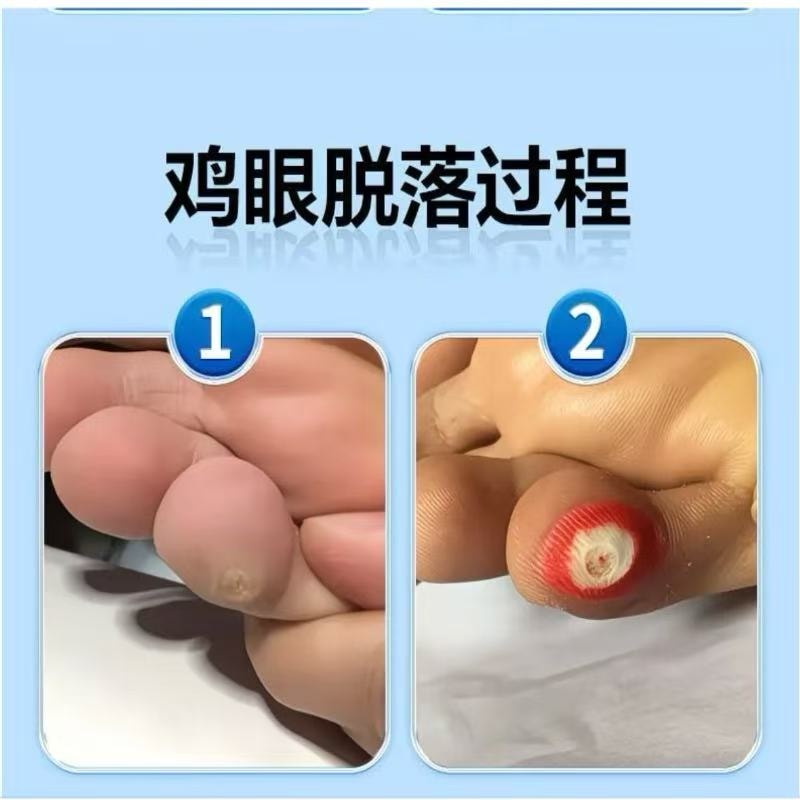 【中國直郵】 甄選好物 葵花雞眼專無痛脫落手足腳底肉刺雞眼腳刺頑固雞眼老繭雞眼貼 1盒/10貼