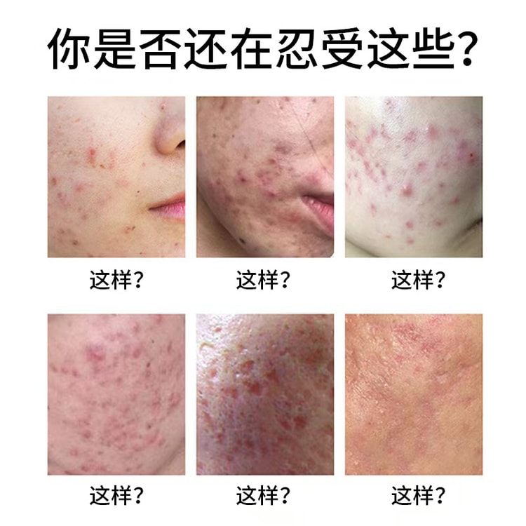 中国からの直送] 香港薬局 ニキビ予防クリーム 30g/箱 ニキビ