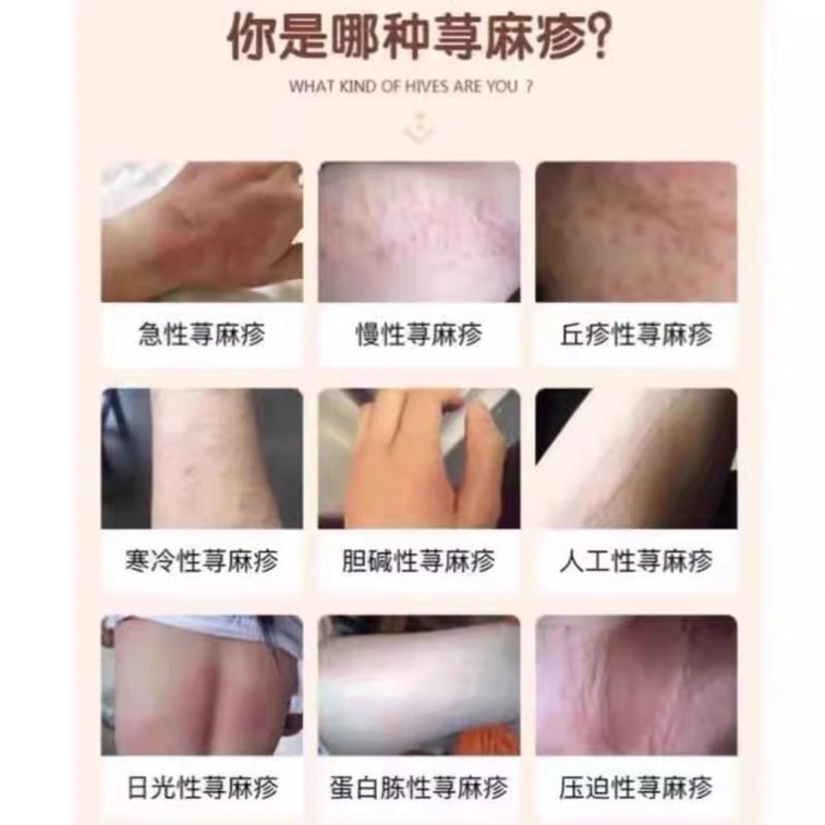 Guizhou Miao Medicine Urticaria Dermatitis Skin Protectant Eczema Ointment Skin Itching Allergy Antibacterial 20g 3