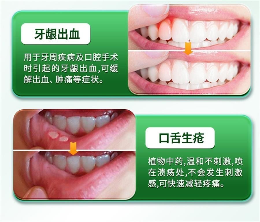 【中國直郵】 摩美得 西帕依固齒泡騰片 治療藥牙齒鬆動專用口腔牙周炎除口臭牙疼 0.6g*3片/盒