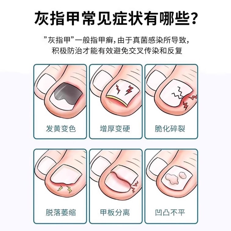 仁和 環吡酮胺乳膏10g 灰指甲治療專用藥膏水正品真菌感染腳氣藥 3