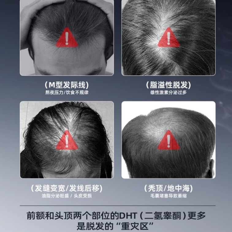 [중국 직배송] Three Magic Hairdressers Kobilo 생강 탈모 방지 샴푸 남성용, 오일 컨트롤, 볼륨 샴푸, 모발 강화 400ml 3