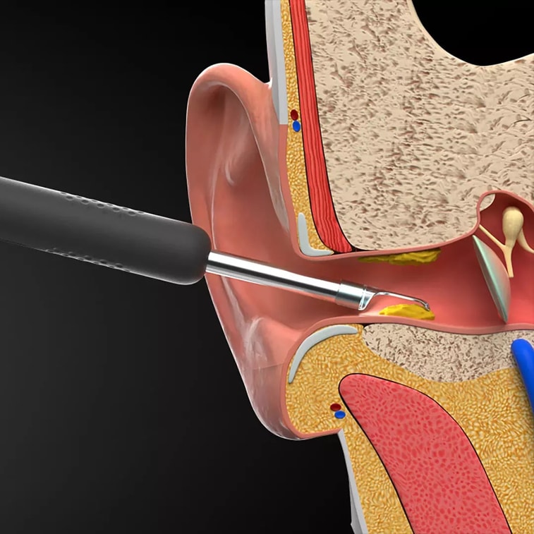 【中国直送】Xiaomi Youpin bebird ハミングバード スマートビジブルイヤースプーン 耳かきスティック R1 ブラック 3