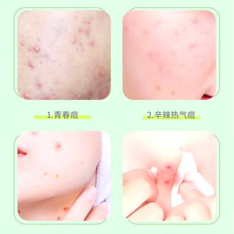 Star-Shaped Acne Patches Emergency Spot Treatment for Acne Inflammation Repairs Scars 5 Colors 200-Piece 3