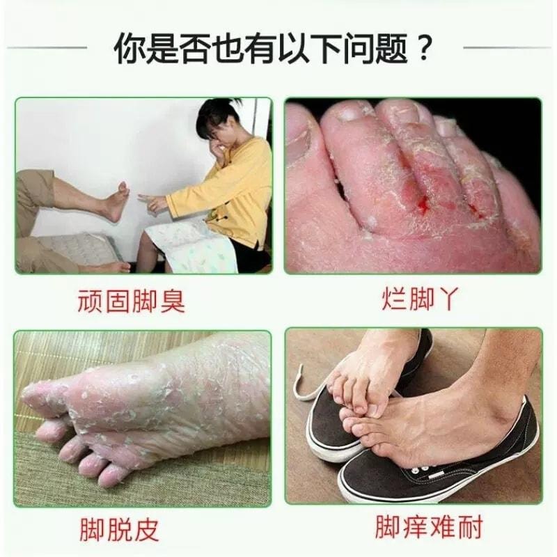 【中国直邮】 仁和 盐酸特比萘芬乳膏 用于治疗手足廯体廯股癣花斑癣皮肤念珠菌脚气 10g/盒(医师推荐拍3盒)