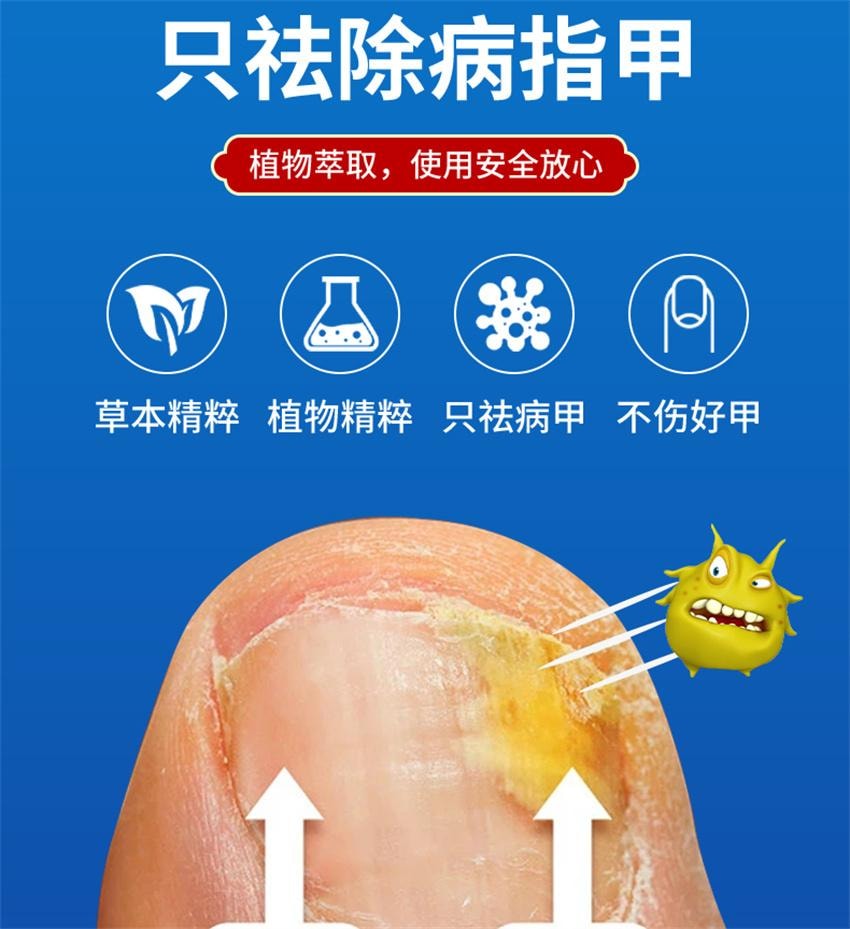 【中国直邮】 祥医堂 阿莫灰甲抑菌擦剂 修复灰指甲脱甲液 阿莫罗芬搽剂灰指甲正品 5ml/盒