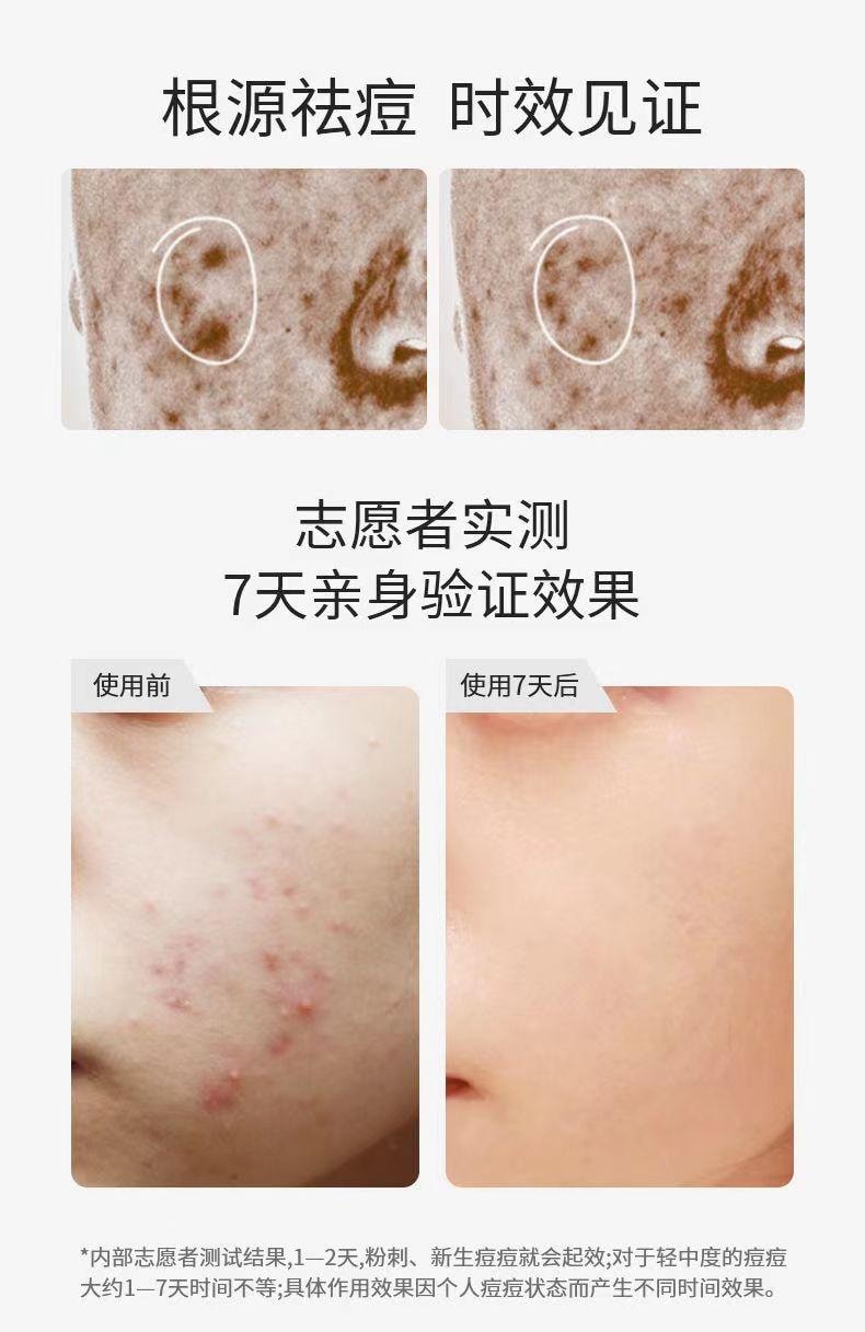  军献 精华去痘膏25g 草本祛痘祛粉刺  淡化痘印 水杨酸包裹细致平滑肌肤