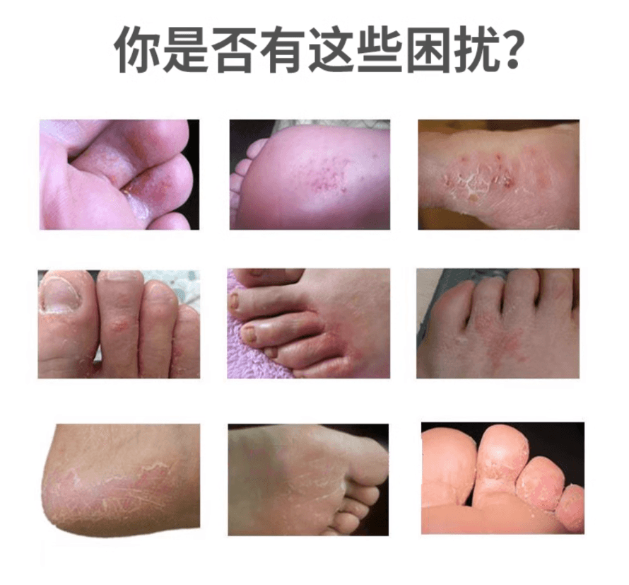 【日本直郵】樂敦腳氣治療藥腳趾周圍/整個足部可用殺菌止癢啫咖哩15克