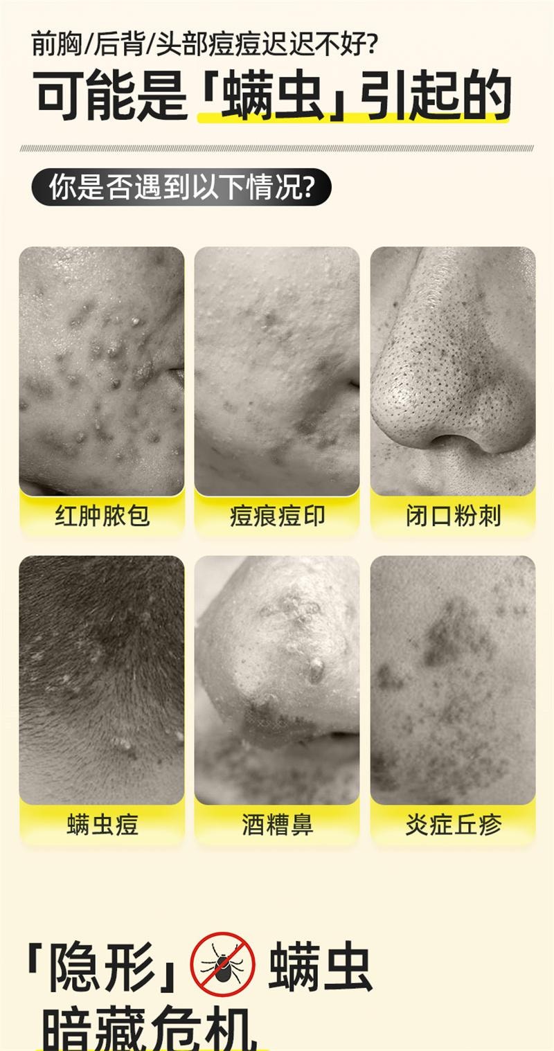【中国直邮】 仁和 新肤螨灵软膏杀除螨虫祛痘痘印痤疮药膏修复淡化祛痘药膏 15g