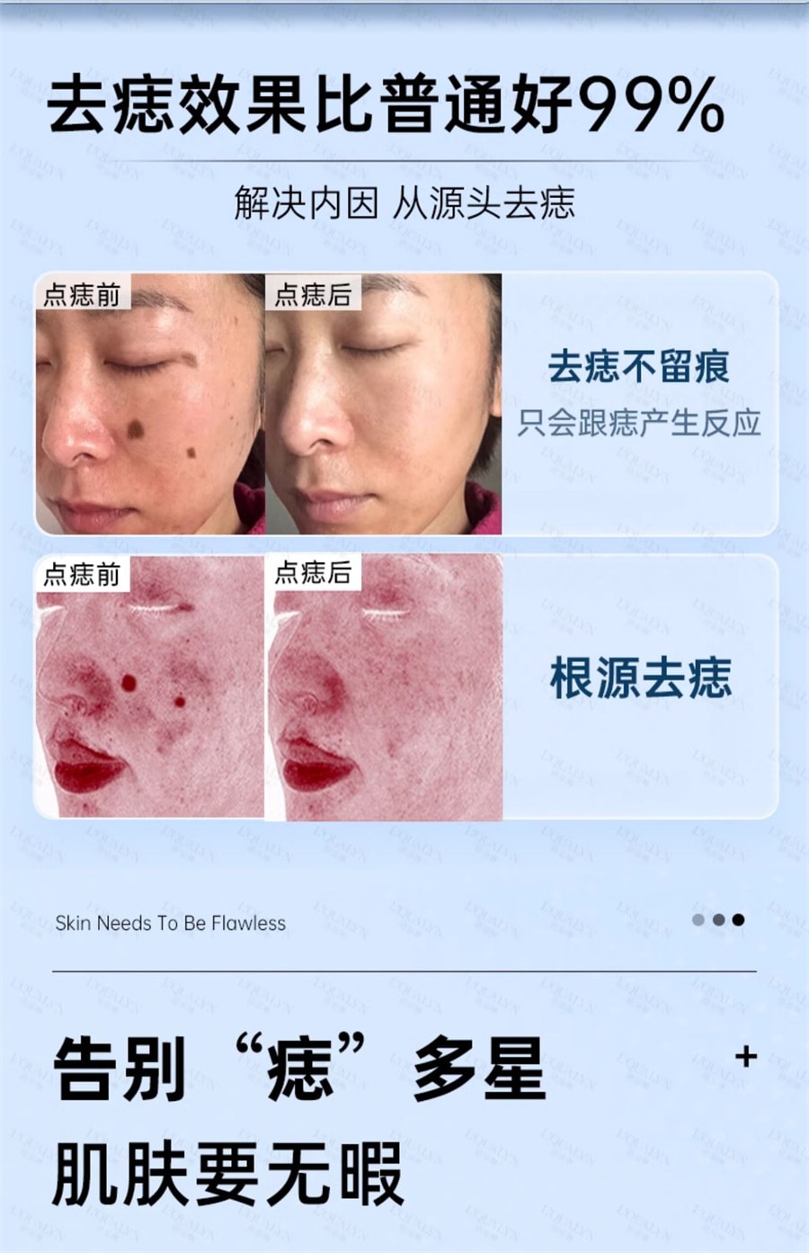 【中国直邮】欧泉琳 点痣膏无痕脸部去痣淡斑神器点痣笔非药水点斑美容专用 5g/瓶+5ml/瓶