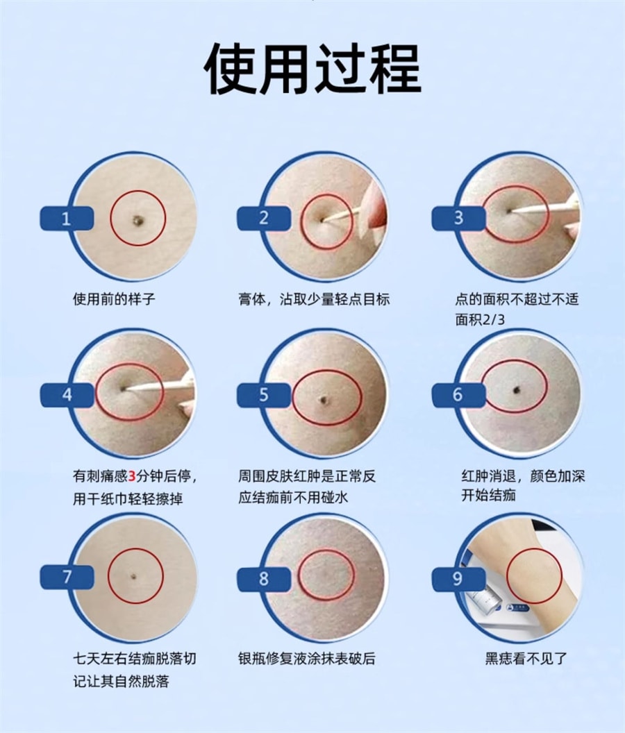 【中国直邮】欧泉琳 点痣膏无痕脸部去痣淡斑神器点痣笔非药水点斑美容专用 5g/瓶+5ml/瓶