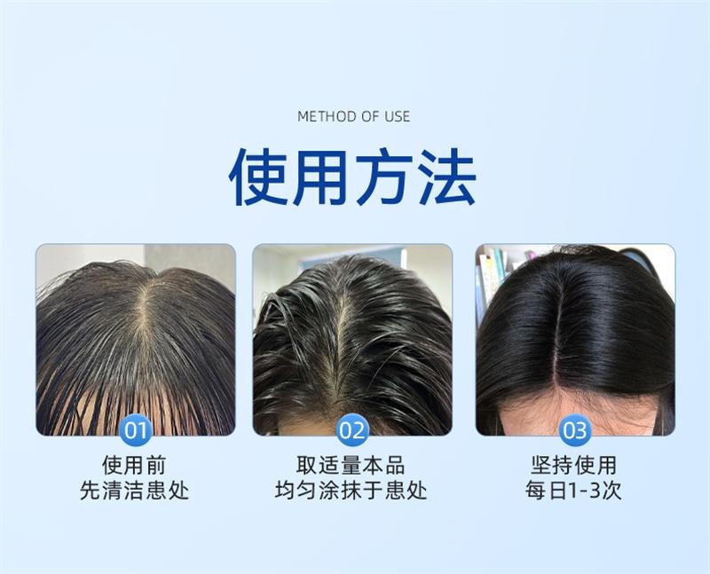 修正 美国  头皮屑脂溢性皮炎真菌感染非药膏治头部银屑癣皮肤痒毛囊炎特效药卡波姆皮肤湿性敷料 20ml