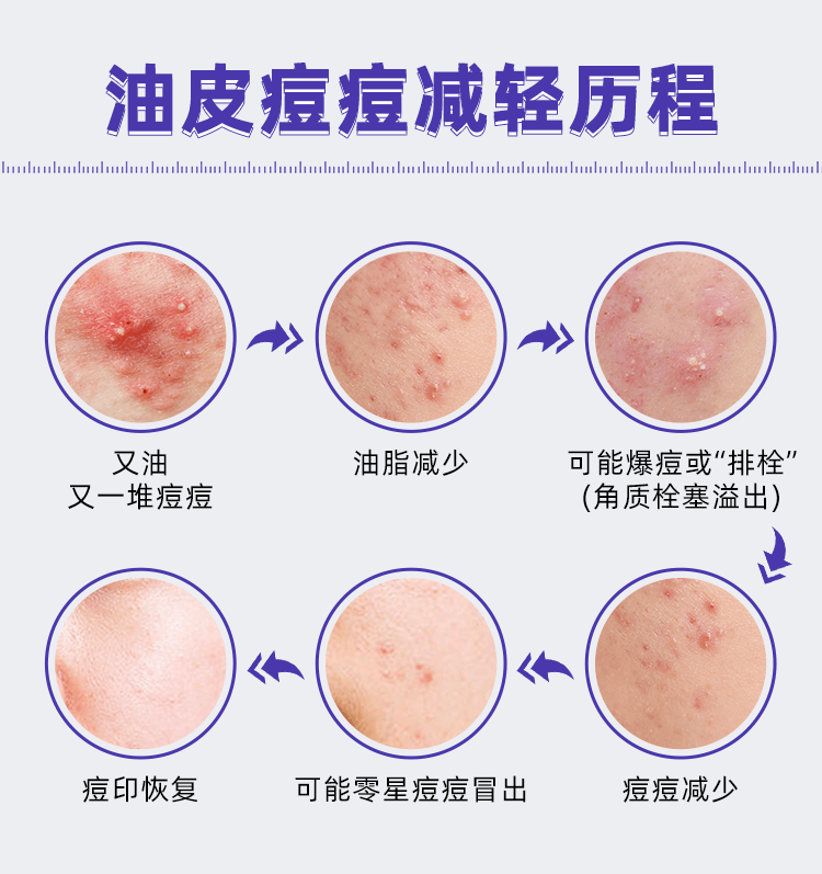 【中国直邮】 丽芙 异维A酸软胶囊10mg*16粒/盒重度痘皮专用药祛痘祛斑
